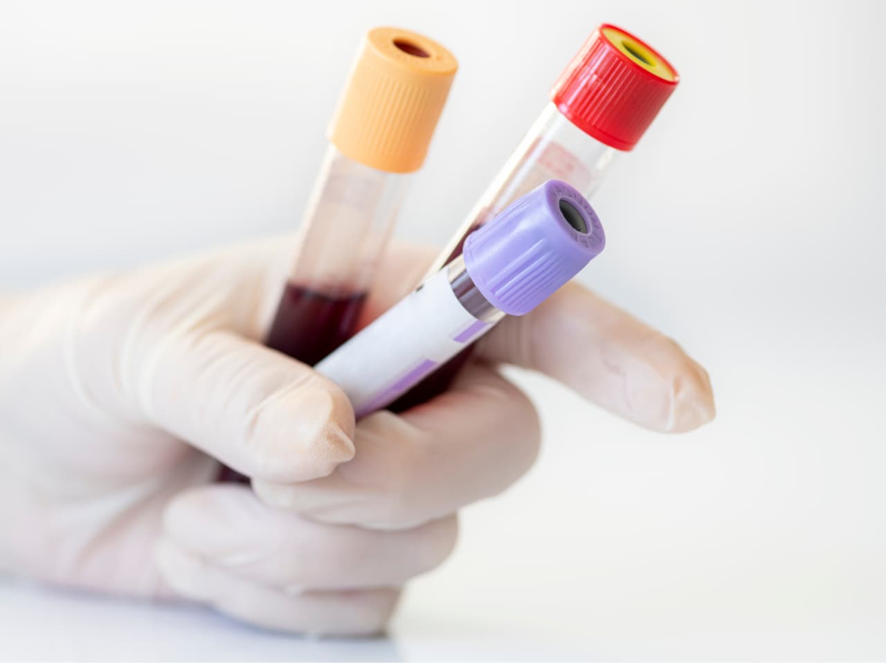 Blood Test for Hair Loss: What to Check and Why It Matters