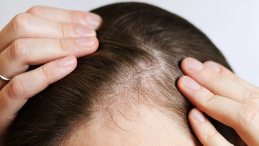 Hair Loss on One Side of Head: Causes and What It Means