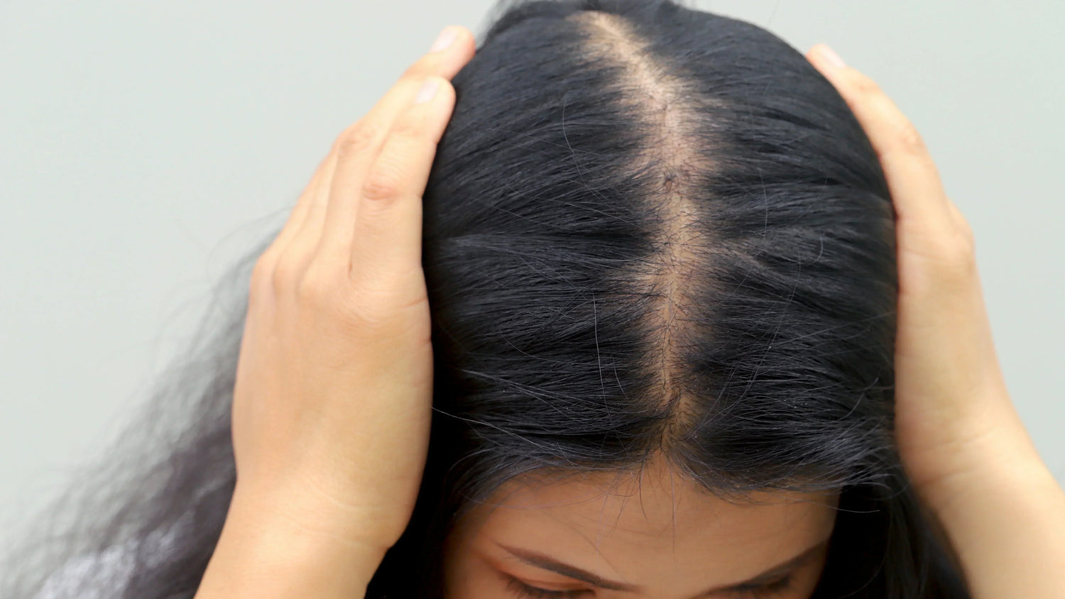Hair Loss in PCOS: Causes and Recovery Options