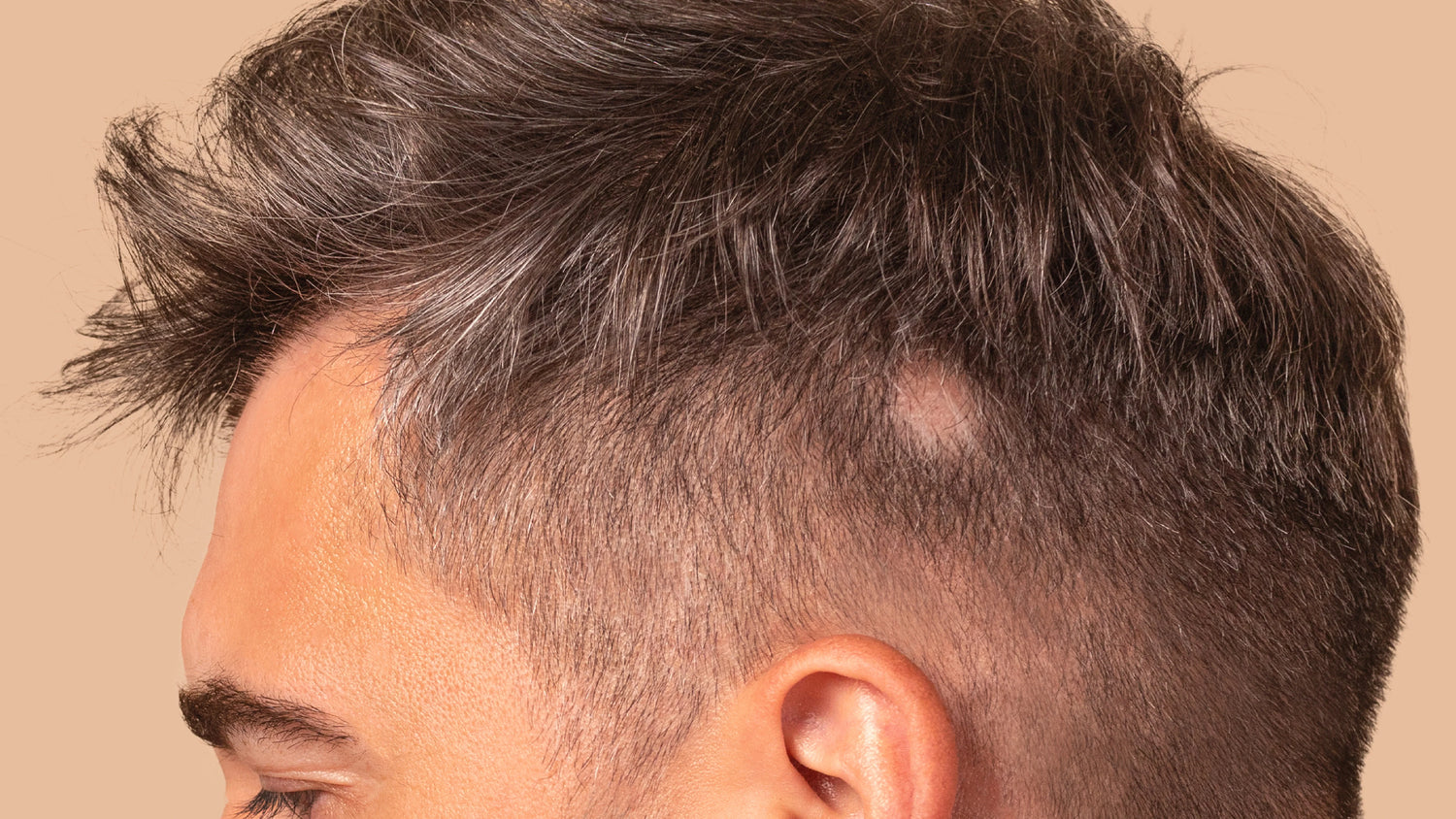 Alopecia Areata Drugs: Treatments, Results, and What Works