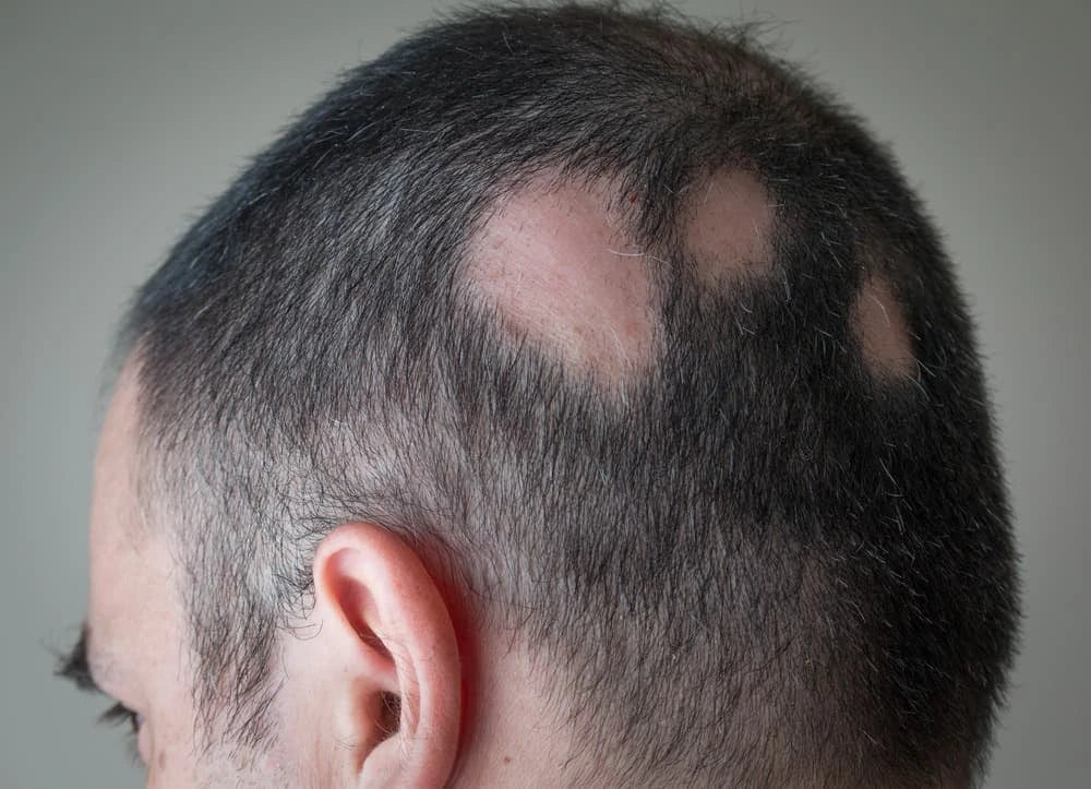 Types of Alopecia: A Guide to the Different Causes of Hair Loss
