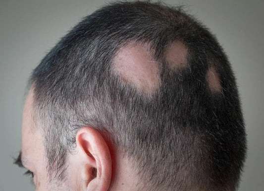 Types of Alopecia: A Guide to the Different Causes of Hair Loss