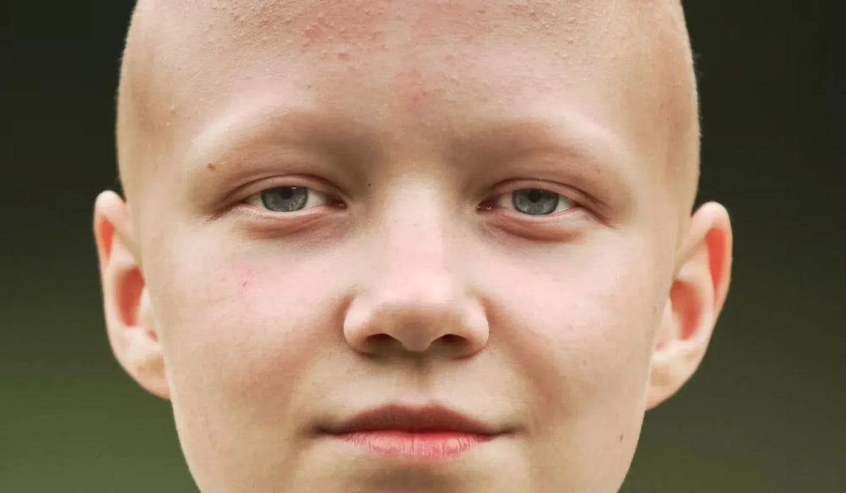 Alopecia Universalis: Causes, Symptoms, and What to Expect