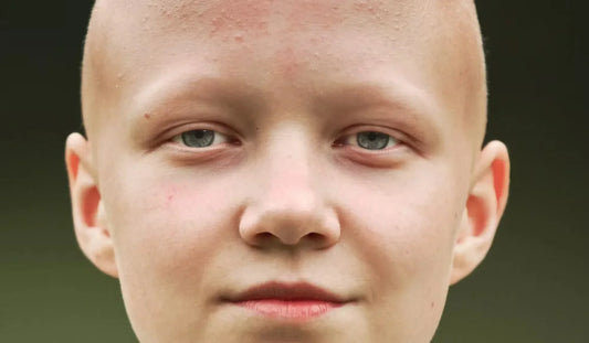 Alopecia Universalis: Causes, Symptoms, and What to Expect