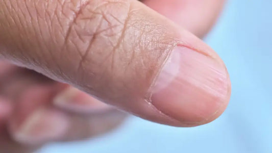 What Is Alopecia Areata in Fingernails and How Is It Treated?