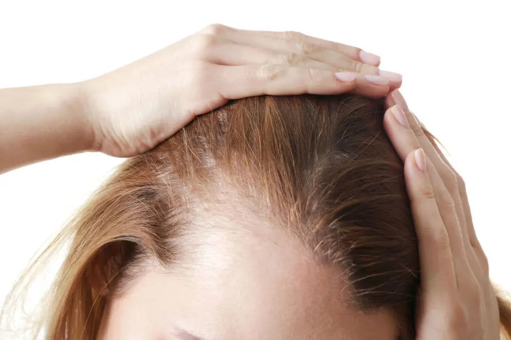 Expert Tips on Androgenetic Alopecia Treatment in Females