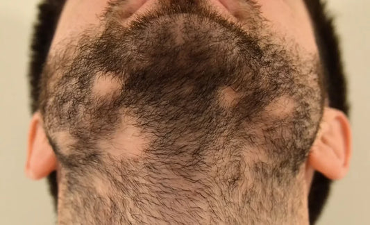 Bald Spot in Beard: Causes, Diagnosis, and Effective Treatments