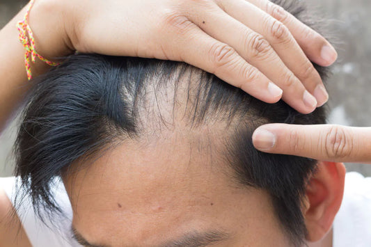 Balding at 22: Causes, Treatments, and Prevention Tips
