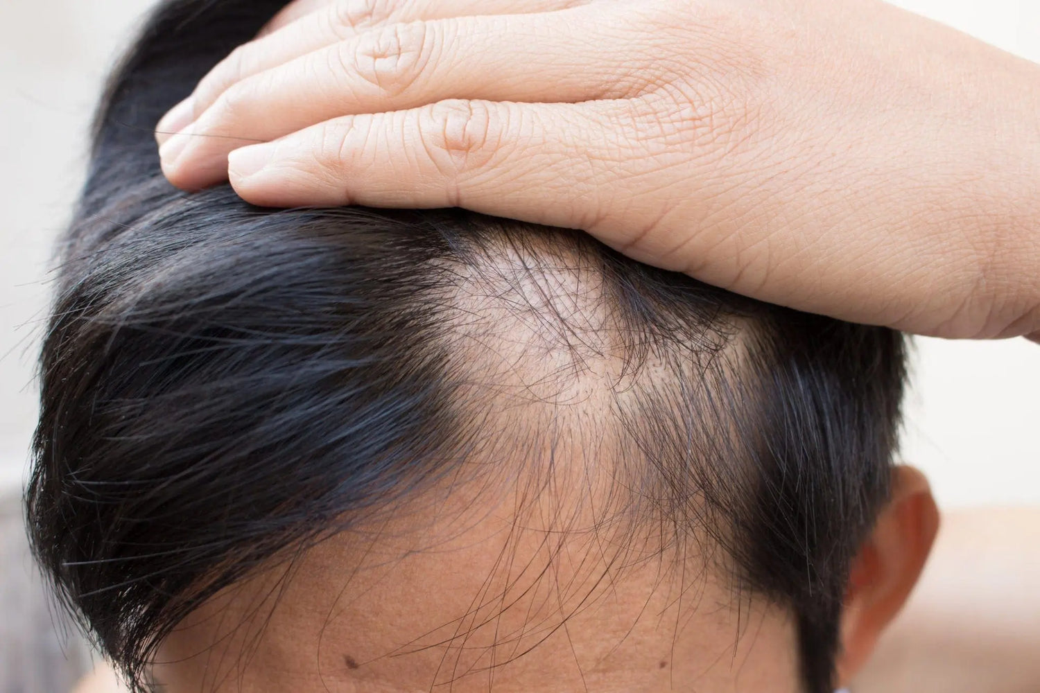 Why Am I Balding at 18? Expert Answers and Real Solutions