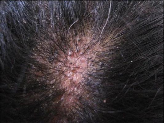 Black Dots in Scalp: Causes, Diagnosis, and Treatment