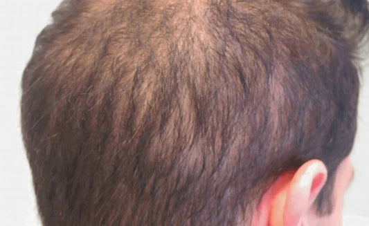 Diffuse Alopecia Solutions for Stronger, Healthier Hair Growth
