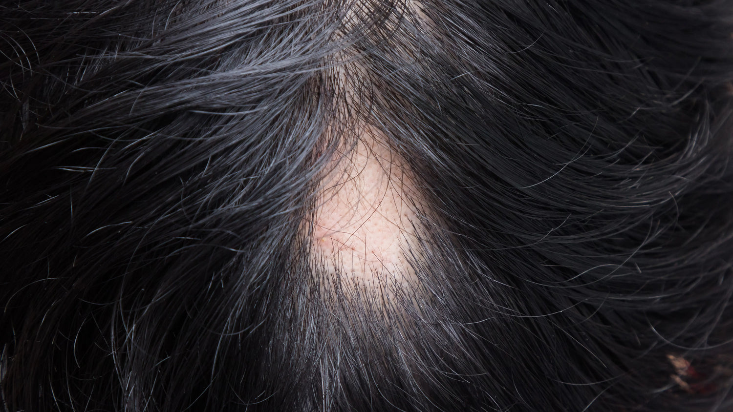 Does Alopecia Areata Go Away? Causes, Symptoms, and Treatment Explained