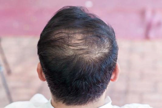 Can It Work? Does Blocking DHT Regrow Hair? Explained