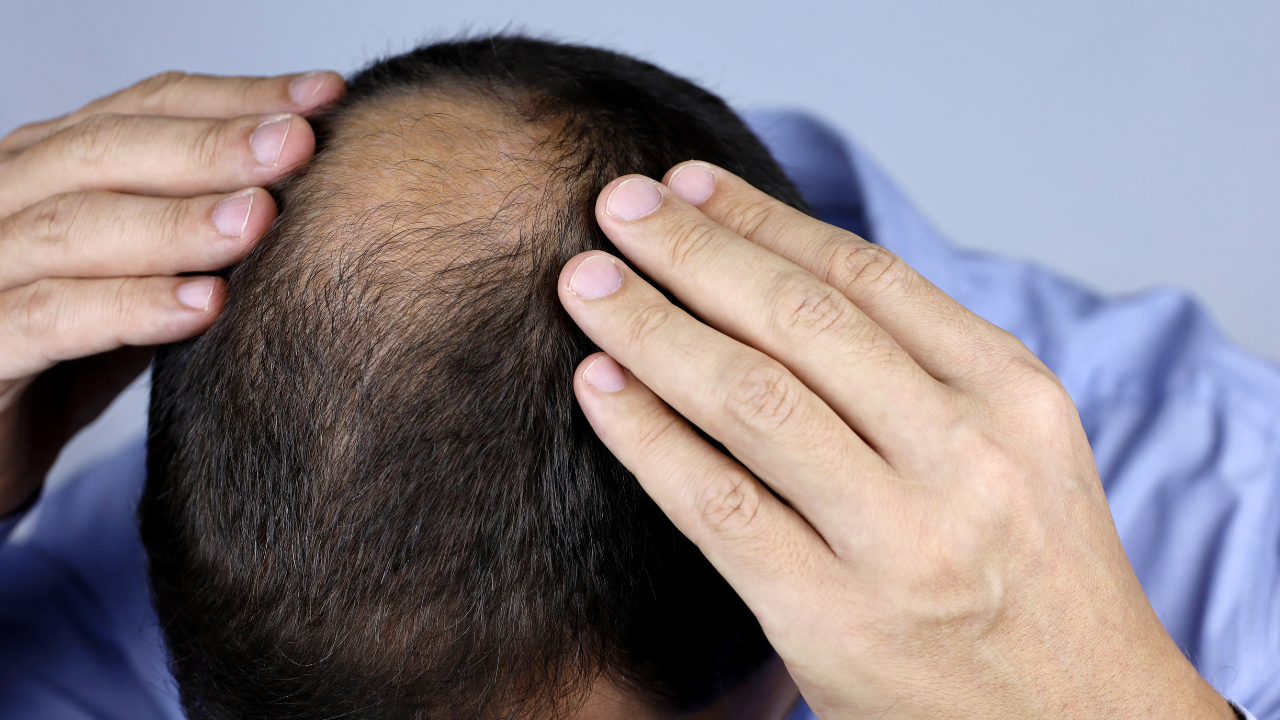 hair loss causes