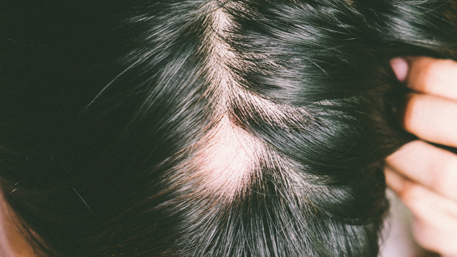 How to Grow Hair Back in a Bald Spot: Causes and Regrowth Explained.