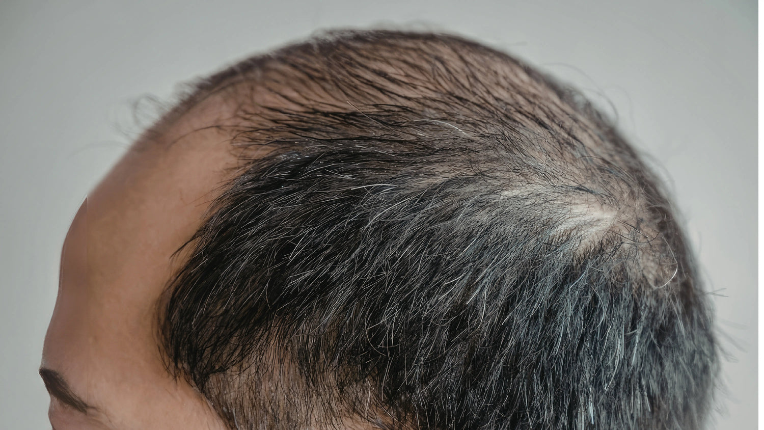 Male Pattern Baldness: Causes, Stages, and Treatments