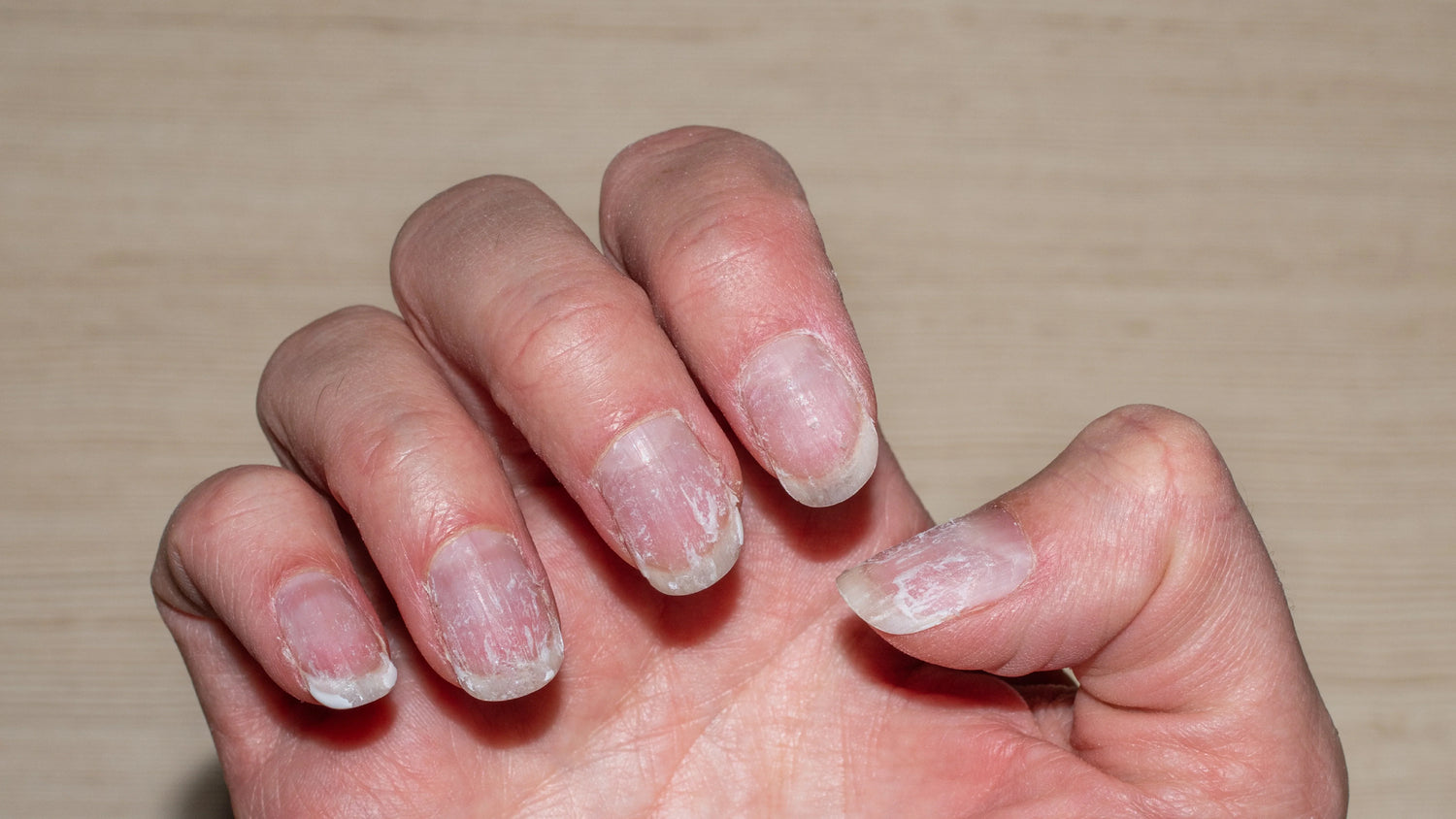 How Thyroid Issues Affect Nails? Nail Changes Explained