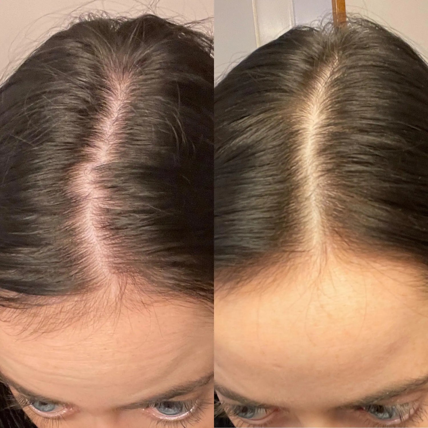 Topical DHT Blocker Explained: How It Works and Limits