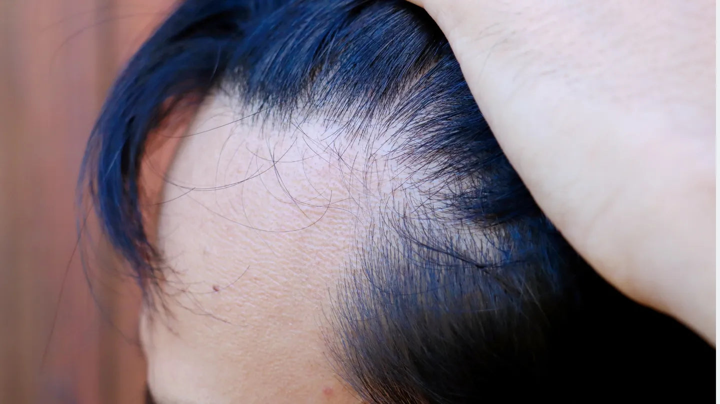Why Does My Hair Line Feel Thinner? Causes and Treatment