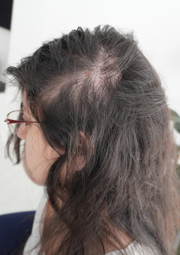Woman with visible scalp and thinning along the part, side view, before