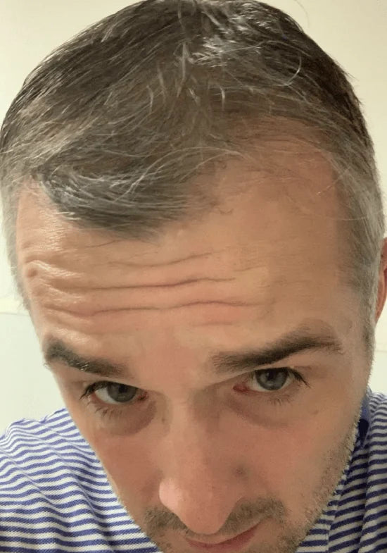Same man with fuller-looking hair on the top of the scalp, front view, after
