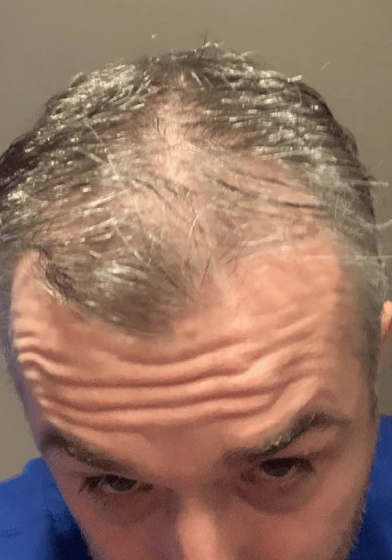 Man with thinning hair on the top and front of the scalp, overhead view, before