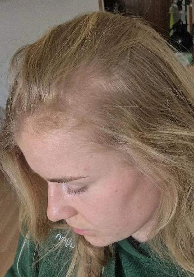 Woman with blonde hair and a widened, thinning part, top view, before
